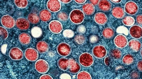Mpox no longer a global emergency, WHO says